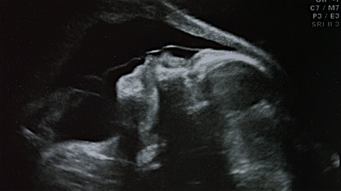 fetal-ultrasound-1600x900.jpg