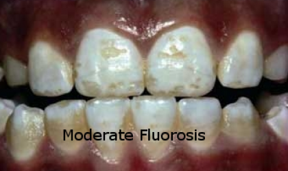 Moderate-Fluorosis