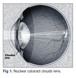 Nov.Cataract.Fig.1