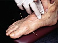 acupuncture.jpg